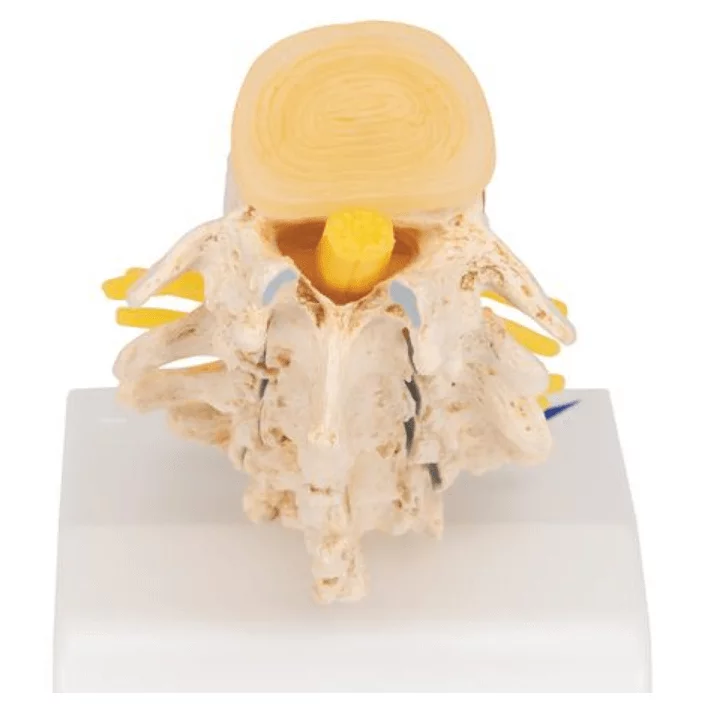  Anatomisch model van Hernia