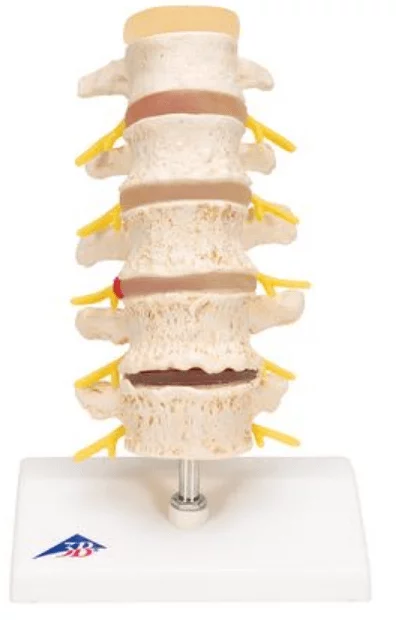  Anatomisch model van Hernia