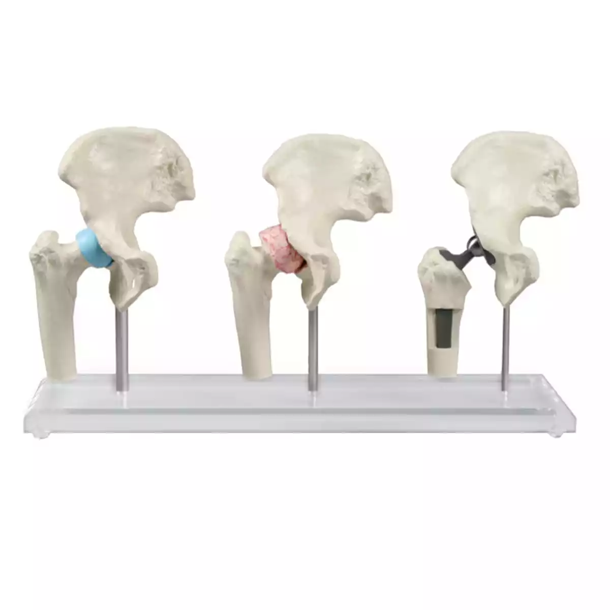  Model heupimplantaat